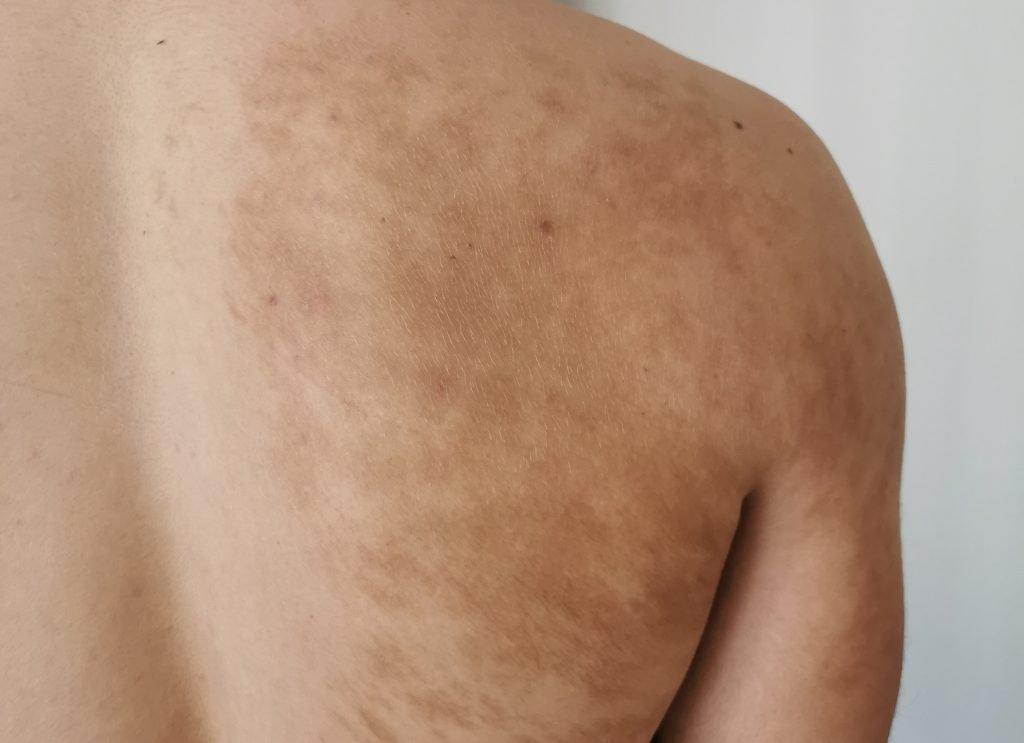 Becker Nevüs (Becker Beni) Dermatoloji uzmanı Dr. Şafak Metekoğlu Akalın