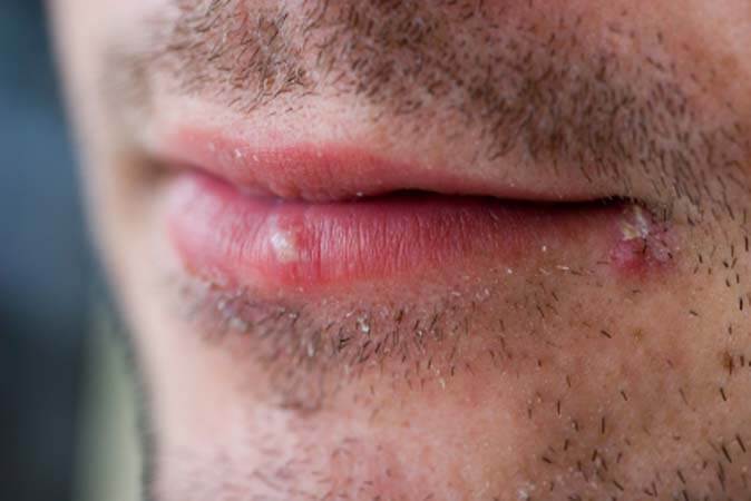Uçukta dudaklar ve ağızda yanma batma hissiyle birlikte yan yana su toplamaları görülür. Herpes simpleks virüsün  neden olduğu bir hastalıktır.