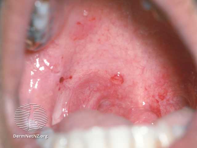 Pemfigus vulgaris hastalığında ağızda olaylıkla patlayıp kanayabilen,  ağrılı ve kaşıntılı su toplamaları gelişir. 